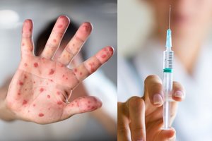 Šiaurės Makedonija skelbia tymų epidemiją visoje šalyje