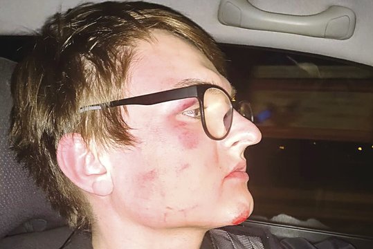 Po akistatos su Lenkijos policija vos liko gyvas