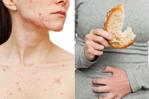 14 požymių, kad jūsų organizmas netoleruoja glitimo 