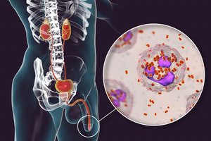 Specialistai įspėjo: plinta pavojinga liga, dėl kurios gresia nevaisingumas