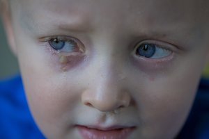 Vilnietę išgąsdino pakitusios vaiko akys: gydytoja paaiškino, kas tai per reiškinys
