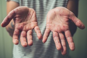 Tymų atvejų skaičius perkopė per šešis šimtus