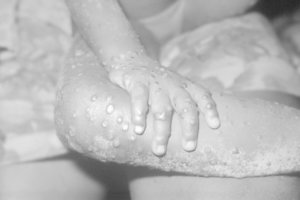 Vyras užsikrėtė beždžionių raupais: užkratas galėjo slypėti vestuvių vaišėse