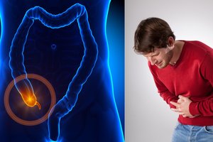 Tiems, kam pašalintas apendiksas, mokslininkai pranešė blogą žinią