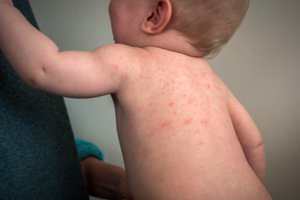 Kolektyvinis imunitetas – patikimiausia priemonė prieš tymus