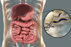 Medikai įspėja: ši bakterija gali sukelti vėžį, o ja užsikrėsti labai lengva