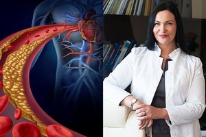 Kardiologė: žmonės klaidingai identifikuoja padidėjusio cholesterolio požymius