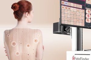 Ankstyvam odos vėžio nustatymui pasitelkė dirbtinį intelektą