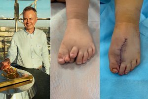 Vilnietis gydytojas išgelbėjo kūdikį, gimusį su aštuoniais kojos pirštais: to matyti dar neteko