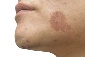 Pasitikrinkite: jūsų oda išduoda apie netikėtas ir net sunkias ligas