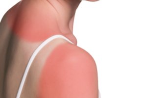 Dėl ligos vilnietė Marija saulėtomis dienomis išgyvena tikrą košmarą