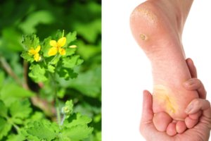 Ši žolelė padės išnaikinti karpas – tereikės patepti kartą per savaitę