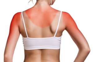 Specialistė patarė, kokios natūralios priemonės išgelbės saulėje nudegusią odą