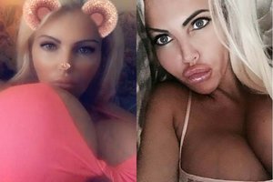 Užpakaliuko operacijoms 50 tūkst. eurų išleidęs modelis siekia rekordo