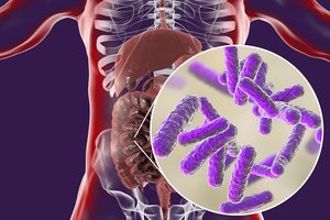 Nemaloni žarnyno liga, kuri ypač paūmėja vasarą: kaip nesusirgti?