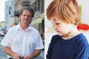 Persirgote vėjaraupiais, bet nebuvote skiepyti? Profesorius įspėjo apie galimas grėsmes