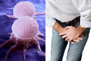 Mokslininkai atrado naują autoimuninę ligą: simptomai susiję su sėklidžių vėžiu