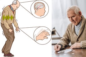 Nustatė, kaip Parkinsono liga susijusi su žarnynu: tai – daug žadantis atradimas