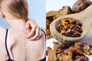 Gydytojas įvardijo vaistą bene nuo visų odos ligų, padeda net vėžio nukankintai odai 