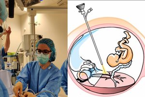 Dar gimdoje esantiems dvyniams Santaros klinikose atliko unikalią operaciją