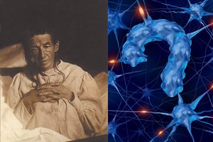 Pirmoji moteris, kuriai buvo diagnozuota Alzheimerio liga, vis kartodavo tą pačią frazę