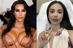 400 tūkst. operacijoms išleidusi Kim Kardashian antrininkė patyrė komplikacijas