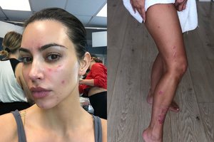 13 metų su sunkia odos būkle kovojančią Kim Kardashian užklupo dar viena liga