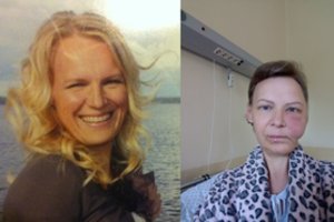 Kaunietės veidą ėda siaubinga liga: beveik visą laiką jaučia skausmą