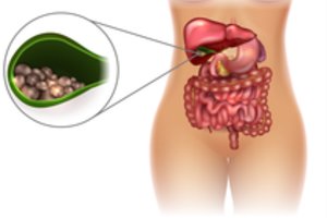 Paprastas būdas, kaip stipriai sumažinti tulžies pūslės akmenligės grėsmę