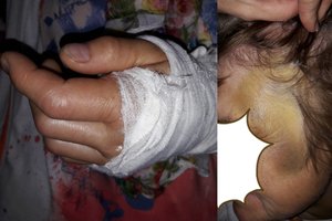 Masažas privačioje klinikoje druskininkietei baigėsi rankos lūžiu