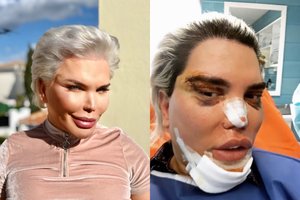 Po gausybės operacijų iškilo grėsmė gyvos lėlės Keno sveikatai: „Aš bijau“