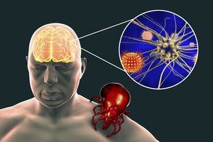 Gydytoja išvardijo pirmuosius erkinio encefalito ir Laimo ligos simptomus: vienas išskirtinis