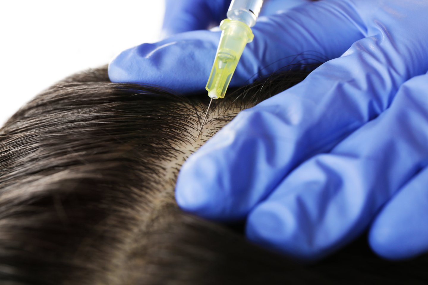 Specialistai sako, kad pacientams, besiskundžiantiems plaukų slinkimu, tačiau dar nenustačius plaukų slinkimo priežasties, neretai atliekamos mezoterapijos ar trombocitais praturtintos plazmos injekcijos.<br> 123rf nuotr.