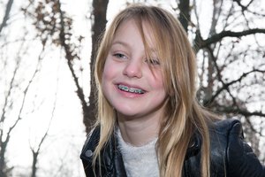 Pamatykite, kaip iš tiesų veikia dantų breketai