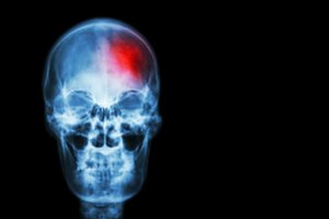 Patikrinimai parodė, kas trukdė dalį insulto pakirstų žmonių išgelbėti laiku