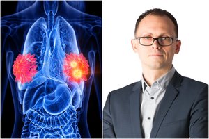 Tai krūties vėžio riziką padidina iki 40 proc.: prie reikšmingo atradimo prisidėjo ir lietuvis