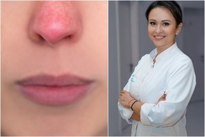 Ši odos problema žiemą kamuoja kas trečią: gydytoja patarė, kas gali padėti