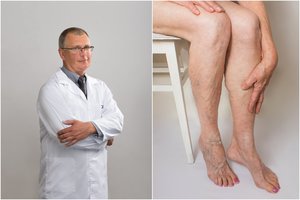 Kraujagyslių chirurgas įspėjo: dėl atrodytų nekaltos ligos gresia staigi mirtis