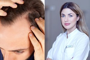 Nuplikimą lemia ne tik genetika: gydytoja įspėjo, kas retina galvos plaukus