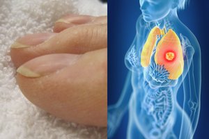 53 metų moters nagai gydytojui išdavė, kad jai – plaučių vėžys: įspėja ir kitus