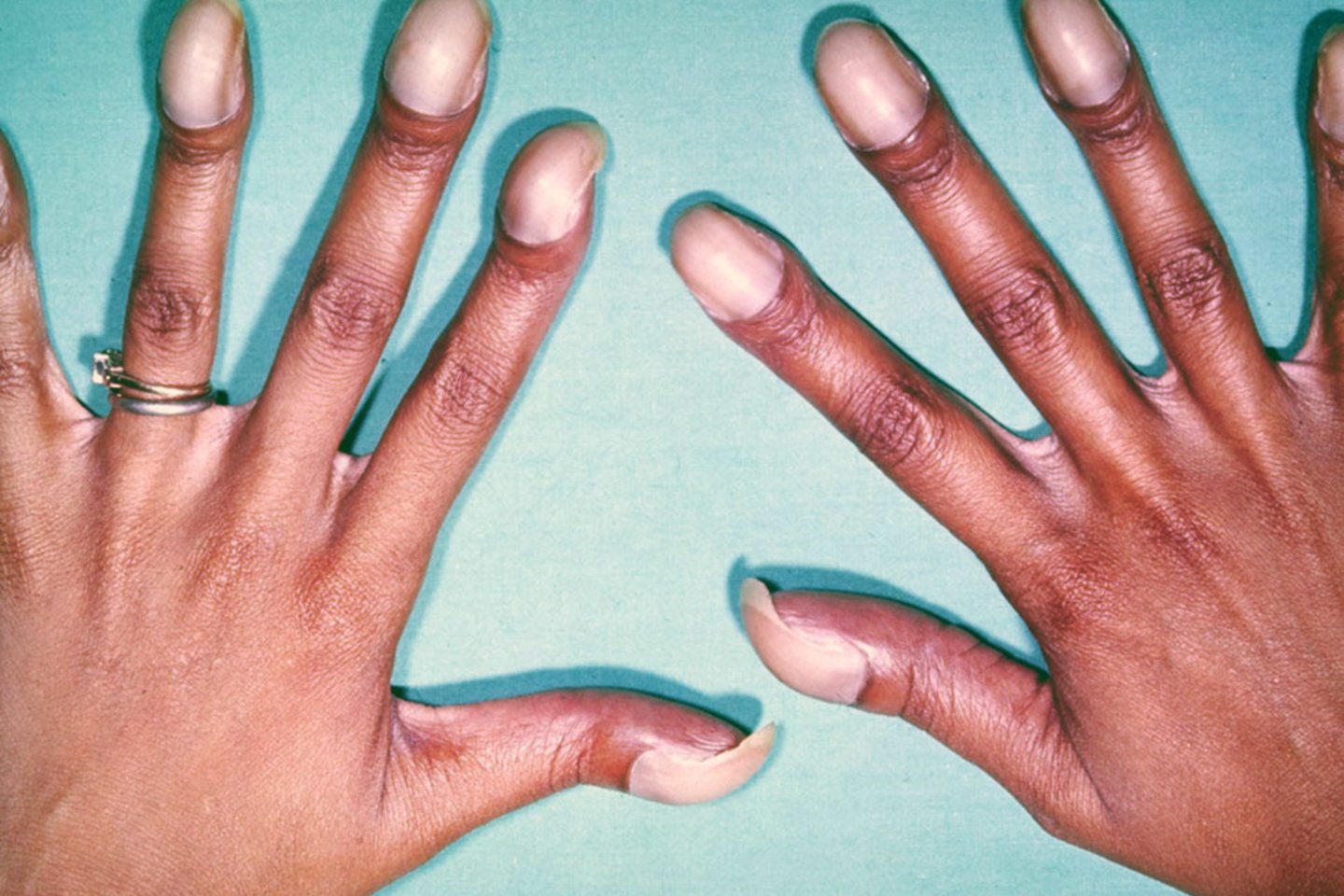 Pakitę nagai ir pirštų galiukai gali būti plaučių vėžio ir kitų grėsmingų ligų požymis.<br>H. L. Fredi ir H. A. van Dijko (Wikipedia.org) nuotr.