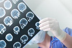 Sergantiems epilepsija – svarbi žinia: keičiasi vaistų skyrimo tvarka