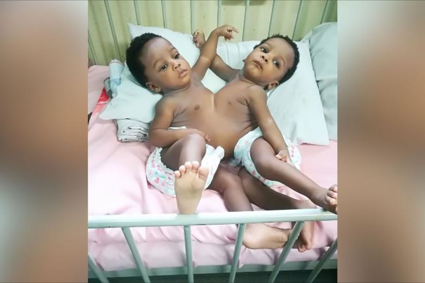  78 gydytojų komanda Nigerijos sostinėje Abudžoje lapkričio mėnesį atliko sėkmingą Siamo dvynių atskyrimo operaciją.<br> Nacionalinės Abudžos ligoninės nuotr.
