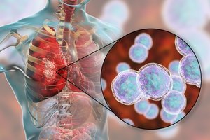 Virusinės pneumonijos protrūkį sukėlė naujas koronavirusas