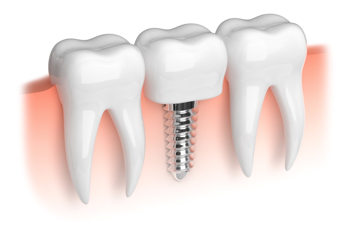 Nors implantacijos kaina yra didesnė, be to, neretais atvejais reikalingas ir prarasto kaulo atstatymas, viską su kaupu atperka patogumas – po atliktos dantų implantacijos pacientas jaučiasi lyg su savais dantimis.<br>123rf nuotr.