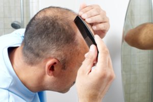 Tyrimas parodė, kas du kartus labiau paspartina nuplikimą