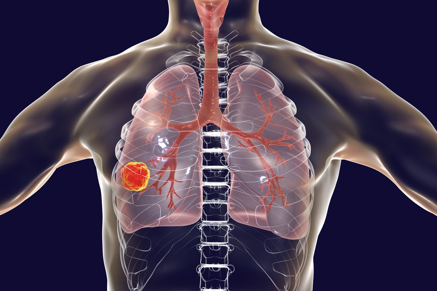 Daugiausia – 9,6 mln. gyvybių – per metus pasaulyje nusinešanti vėžio forma yra plaučių vėžys.<br>123rf nuotr.