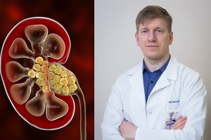 Inkstų akmenys – lyg tiksinti bomba organizme: patarė, kaip nuo to apsisaugoti