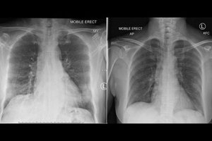 Proveržis: mokslininkai atsekė, kaip imuninė sistema reaguoja į Covid-19 virusą