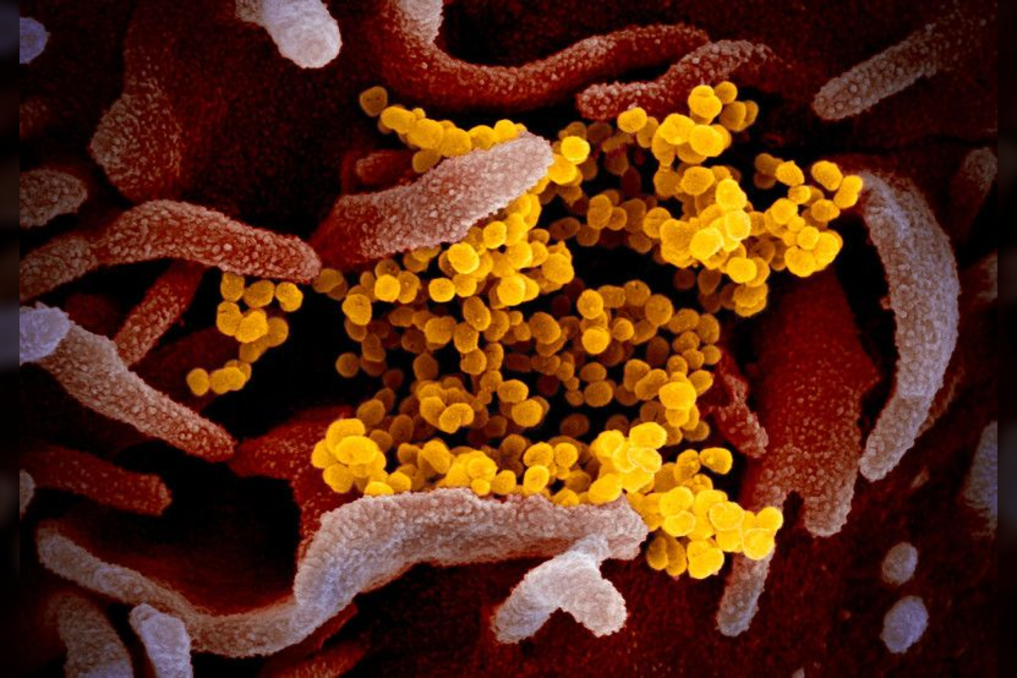 Šis skenčiojo elektroninio mikroskopo vaizdas rodo virusą SARS-CoV-2 (geltona spalva) tarp žmogaus ląstelių (purpurinė spalva).<br> NIAID-RML nuotr.
